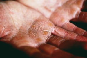 cracks and scars on a person's hands